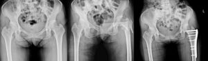 X-ray of a hip fracture, commonly seen after falls abroad